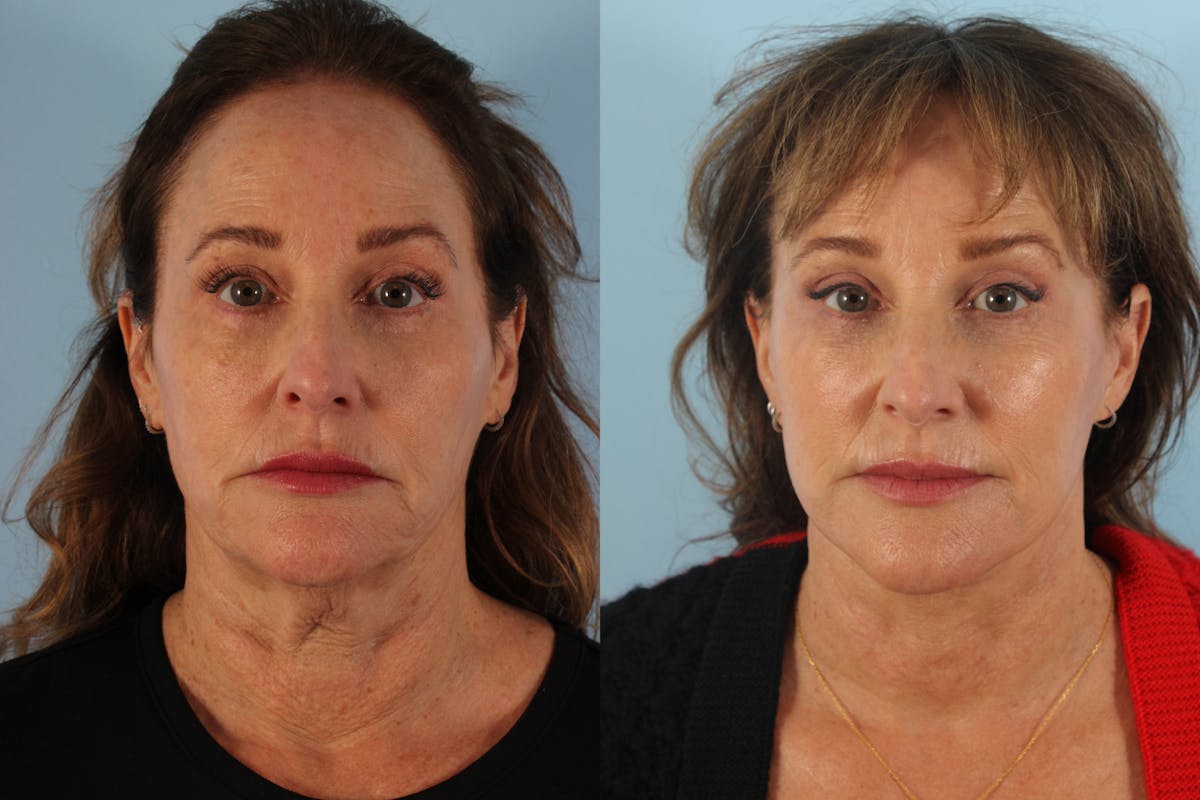 Facelift Surgery Before & After Gallery - Patient 414791 - Image 1