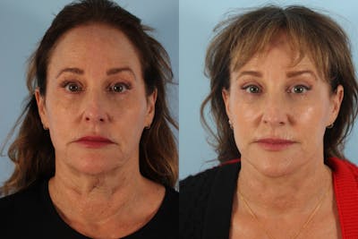 Facelift Surgery Before & After Gallery - Patient 414791 - Image 1