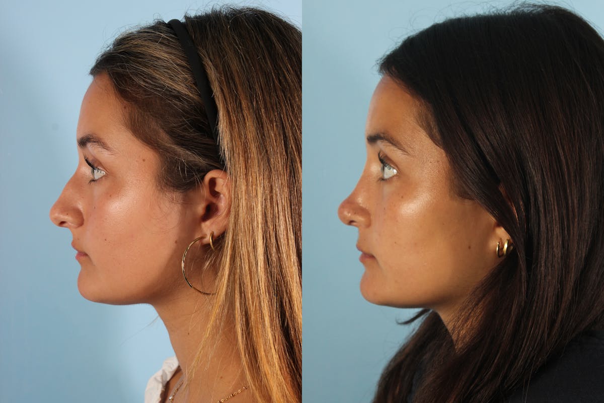 Rhinoplasty Before & After Gallery - Patient 270377 - Image 1