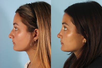 Rhinoplasty Before & After Gallery - Patient 270377 - Image 1