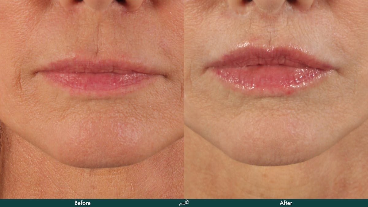 Lip Lift / Implants Before & After Gallery - Patient 255073 - Image 1