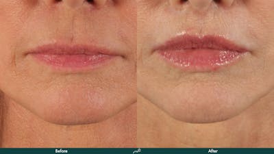 Lip Lift / Implants Before & After Gallery - Patient 255073 - Image 1