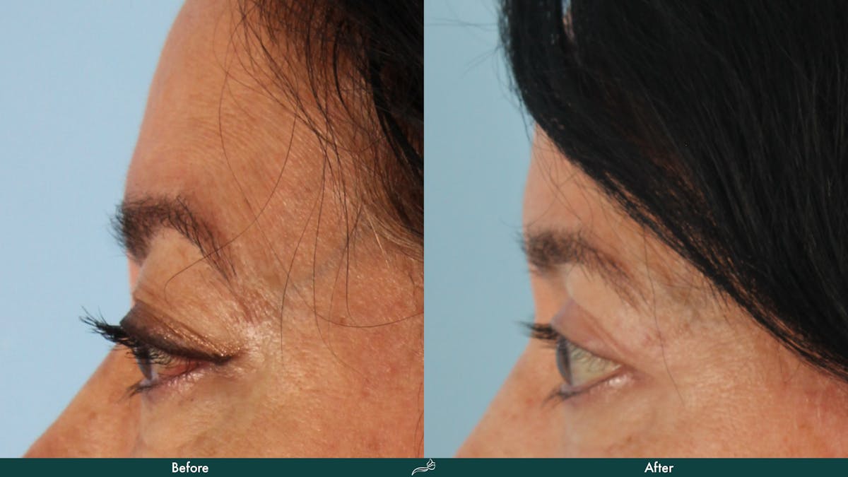 Upper Blepharoplasty Before & After Gallery - Patient 374082 - Image 3