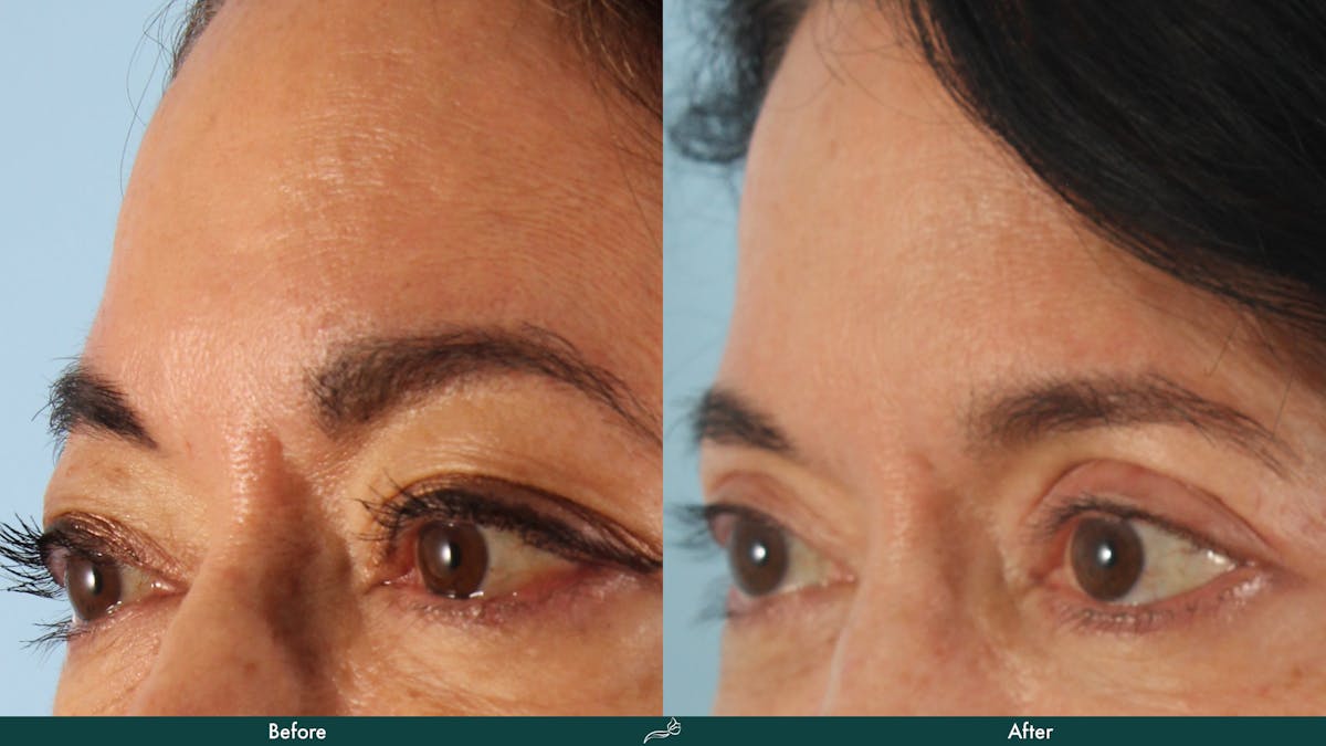 Upper Blepharoplasty Before & After Gallery - Patient 374082 - Image 2