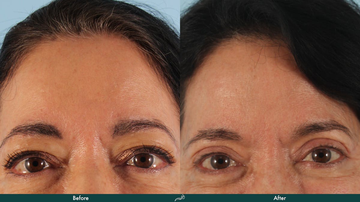 Upper Blepharoplasty Before & After Gallery - Patient 374082 - Image 1