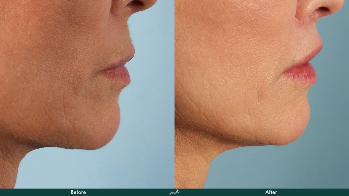 Fat Transfer Before & After Gallery - Patient 340902 - Image 2