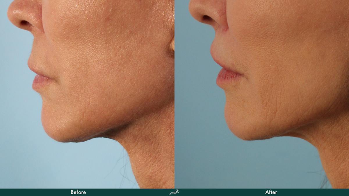 Fat Transfer Before & After Gallery - Patient 340902 - Image 3