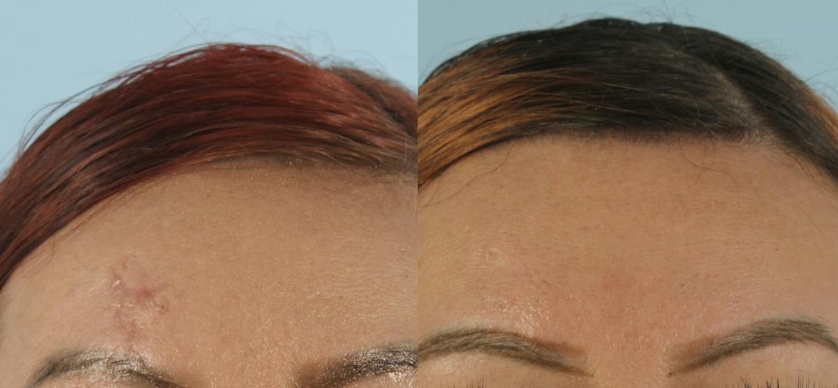 Scarlet RF Microneedling Before & After Gallery - Patient 415638 - Image 1