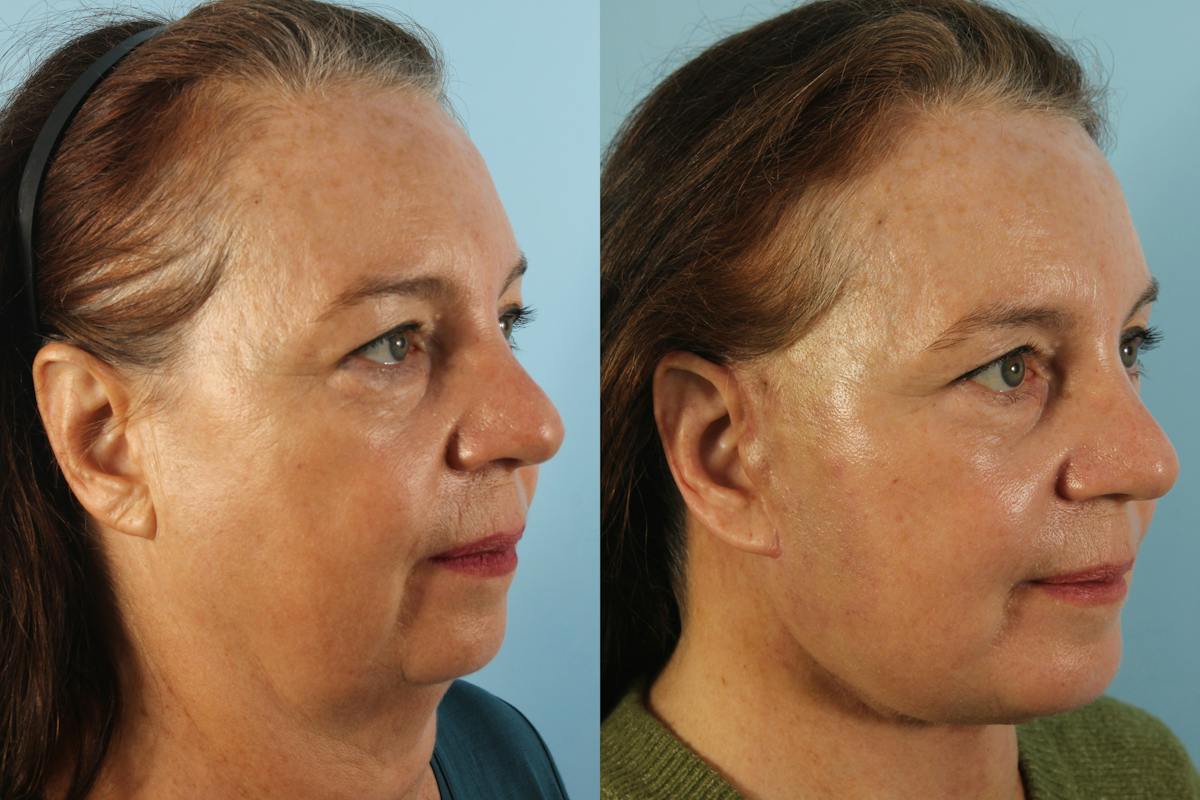 Liposuction Submental Before & After Gallery - Patient 319763 - Image 3