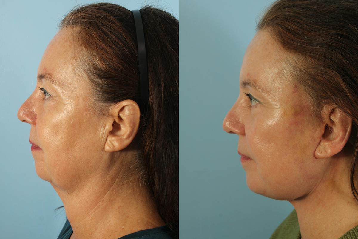 Liposuction Submental Before & After Gallery - Patient 319763 - Image 2