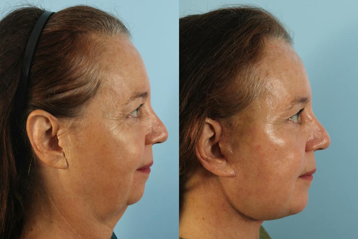 Liposuction Submental Before & After Gallery - Patient 319763 - Image 4