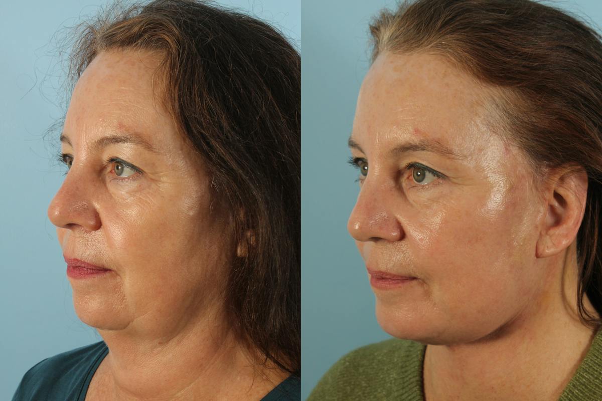 Liposuction Submental Before & After Gallery - Patient 319763 - Image 1