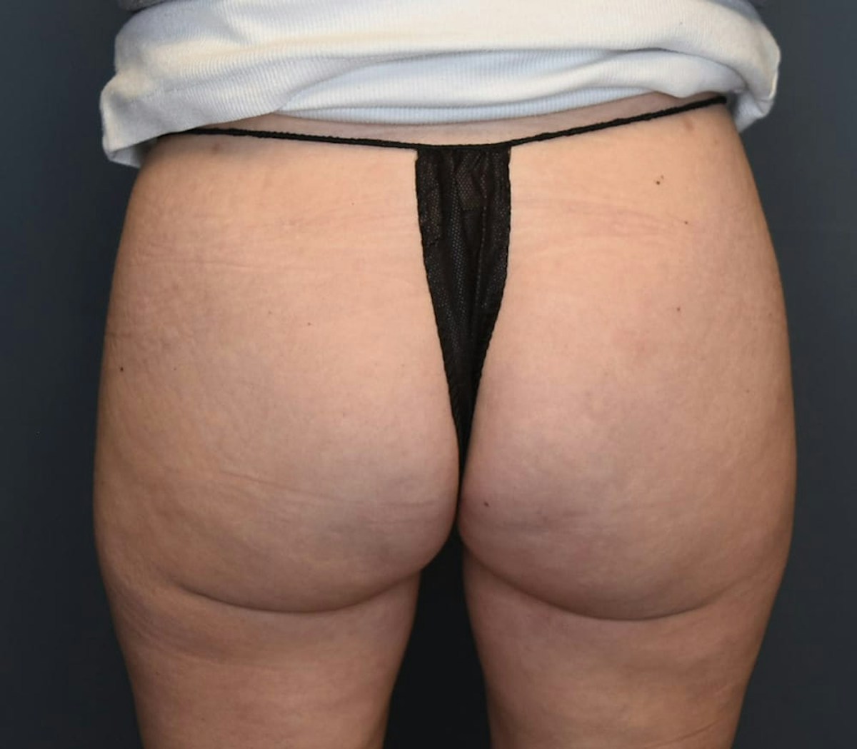 Aveli Before & After Gallery - Patient 127506 - Image 2