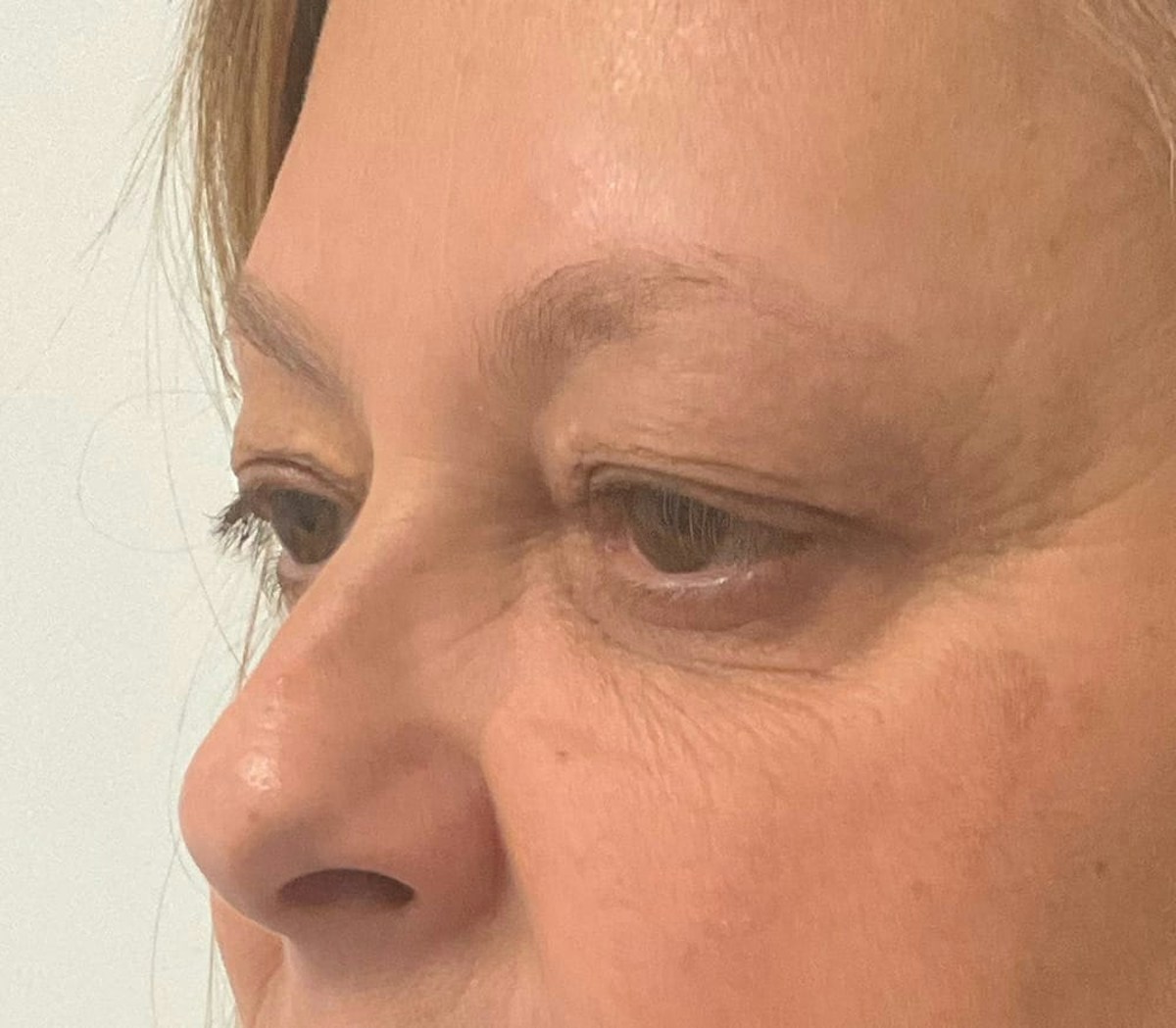 Blepharoplasty Before & After Gallery - Patient 175356 - Image 3