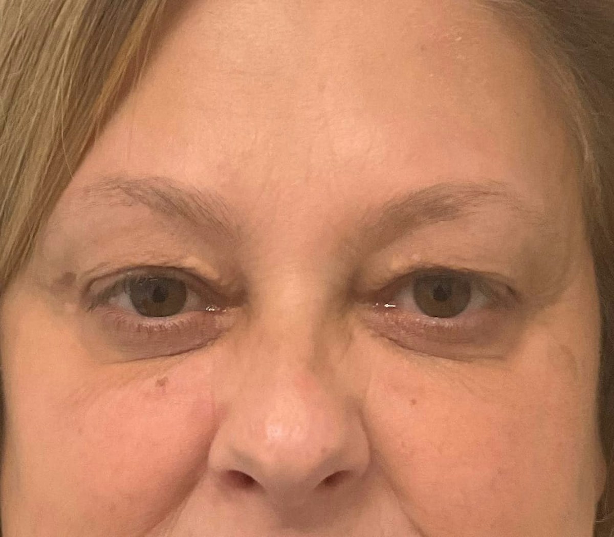 Blepharoplasty Before & After Gallery - Patient 175356 - Image 5
