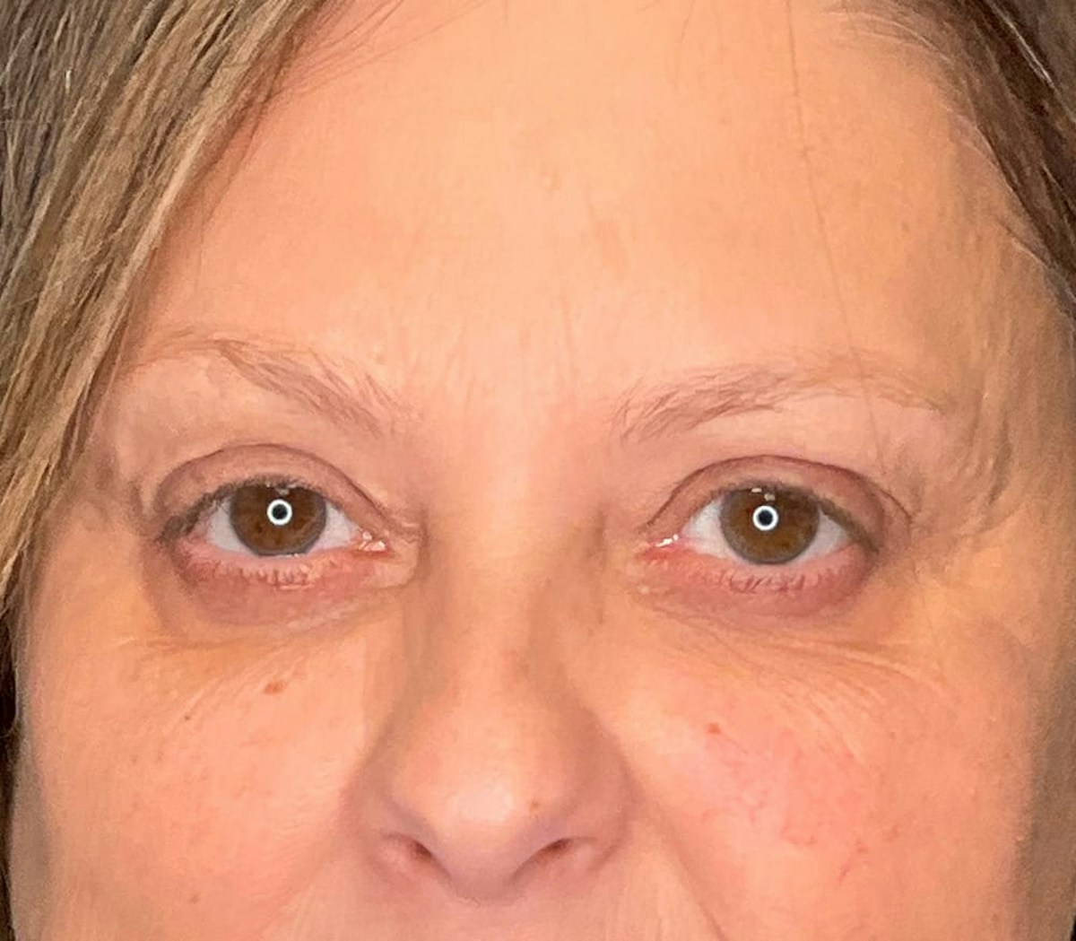 Blepharoplasty Before & After Gallery - Patient 175356 - Image 6