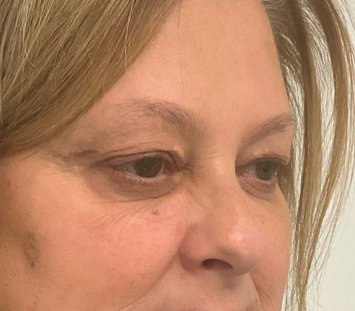 Blepharoplasty Before & After Gallery - Patient 175356 - Image 1