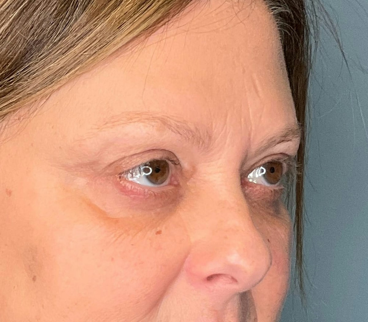 Blepharoplasty Before & After Gallery - Patient 175356 - Image 2