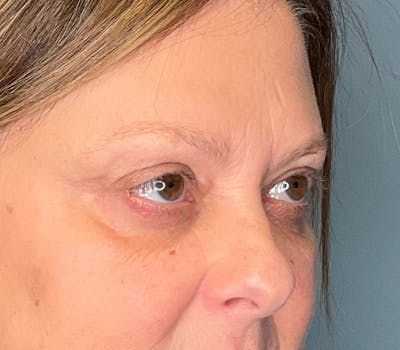 Blepharoplasty Before & After Gallery - Patient 175356 - Image 2