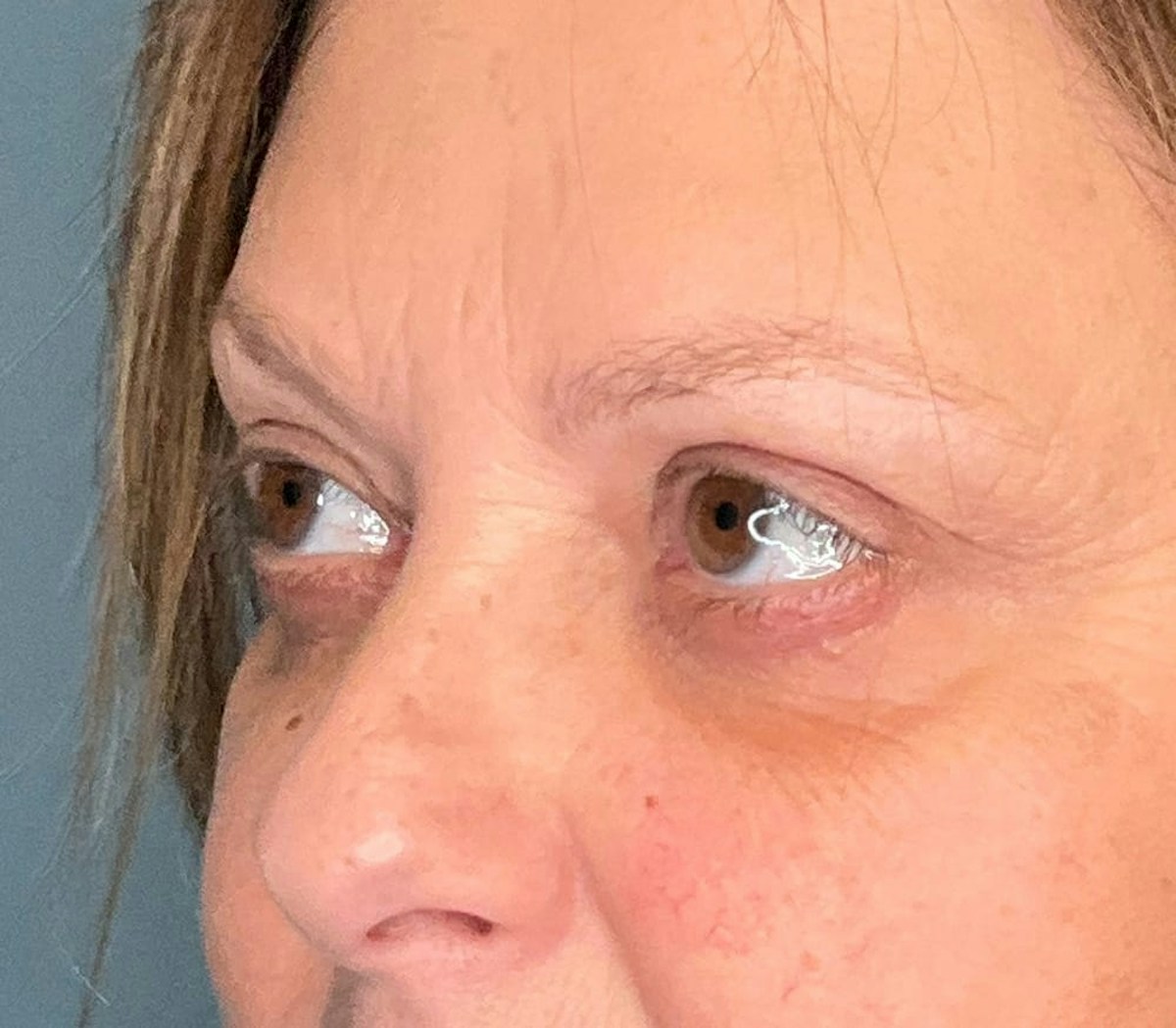 Blepharoplasty Before & After Gallery - Patient 175356 - Image 4