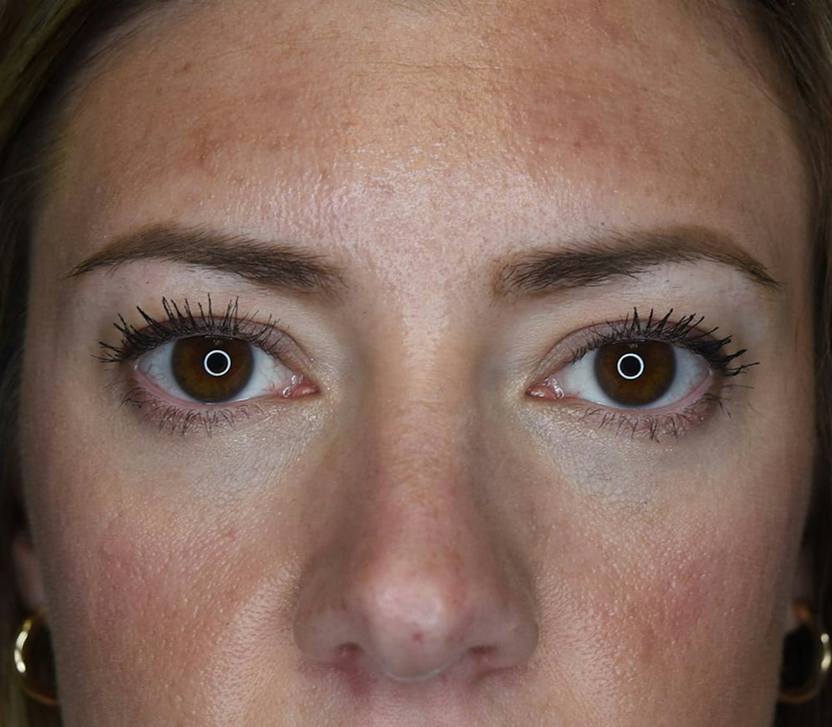 Blepharoplasty Before & After Gallery - Patient 186023 - Image 5