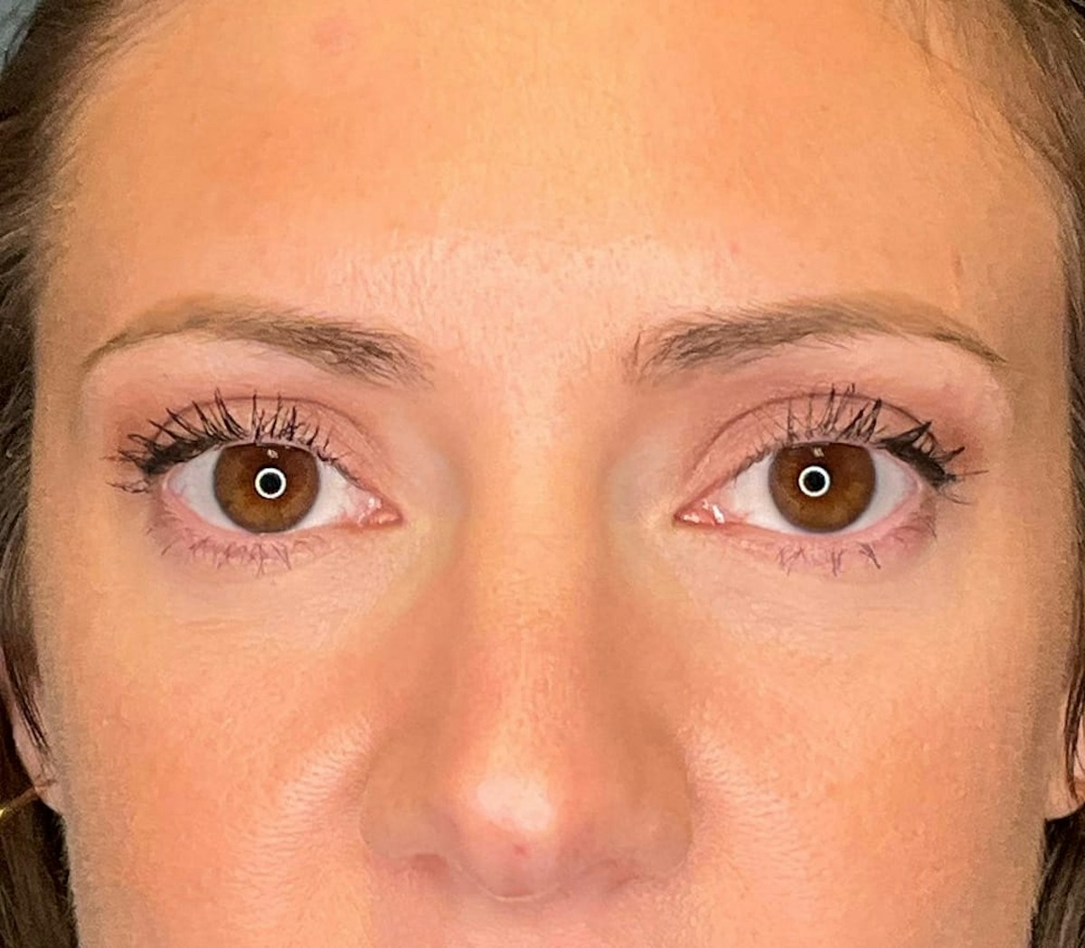 Blepharoplasty Before & After Gallery - Patient 186023 - Image 6
