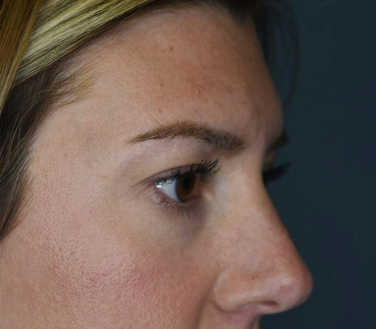 Blepharoplasty Before & After Gallery - Patient 186023 - Image 1