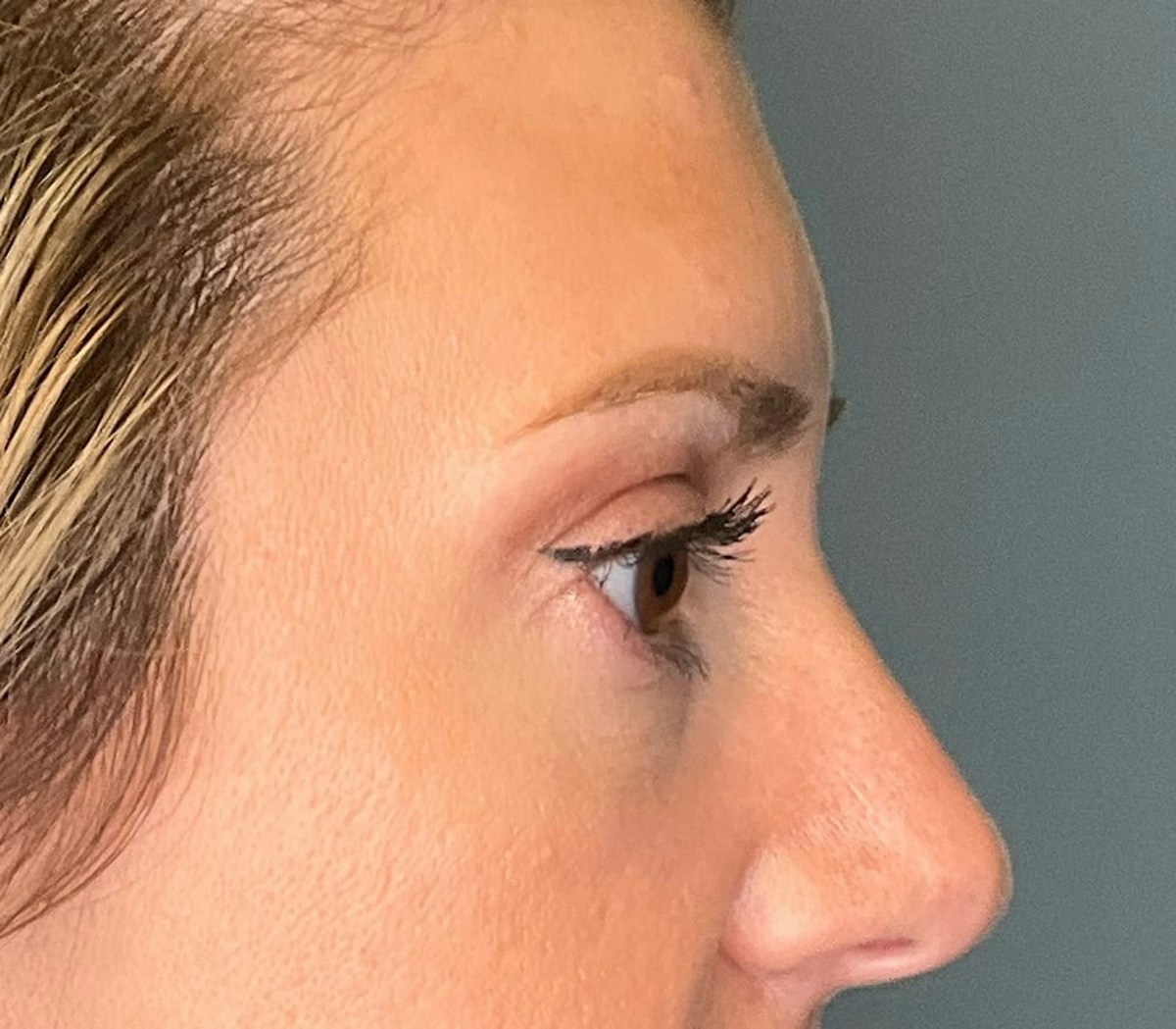 Blepharoplasty Before & After Gallery - Patient 186023 - Image 2