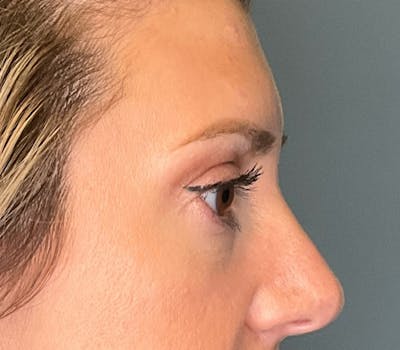 Blepharoplasty Before & After Gallery - Patient 186023 - Image 2