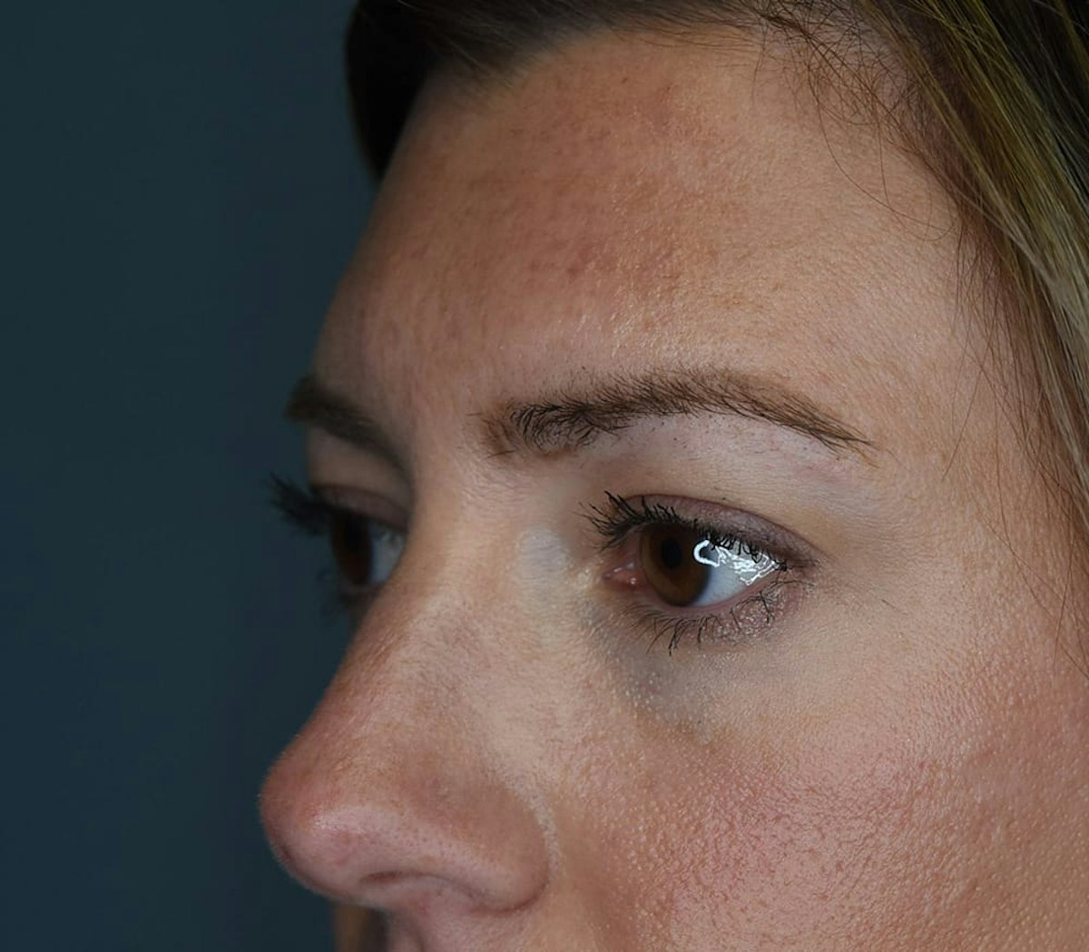 Blepharoplasty Before & After Gallery - Patient 186023 - Image 3