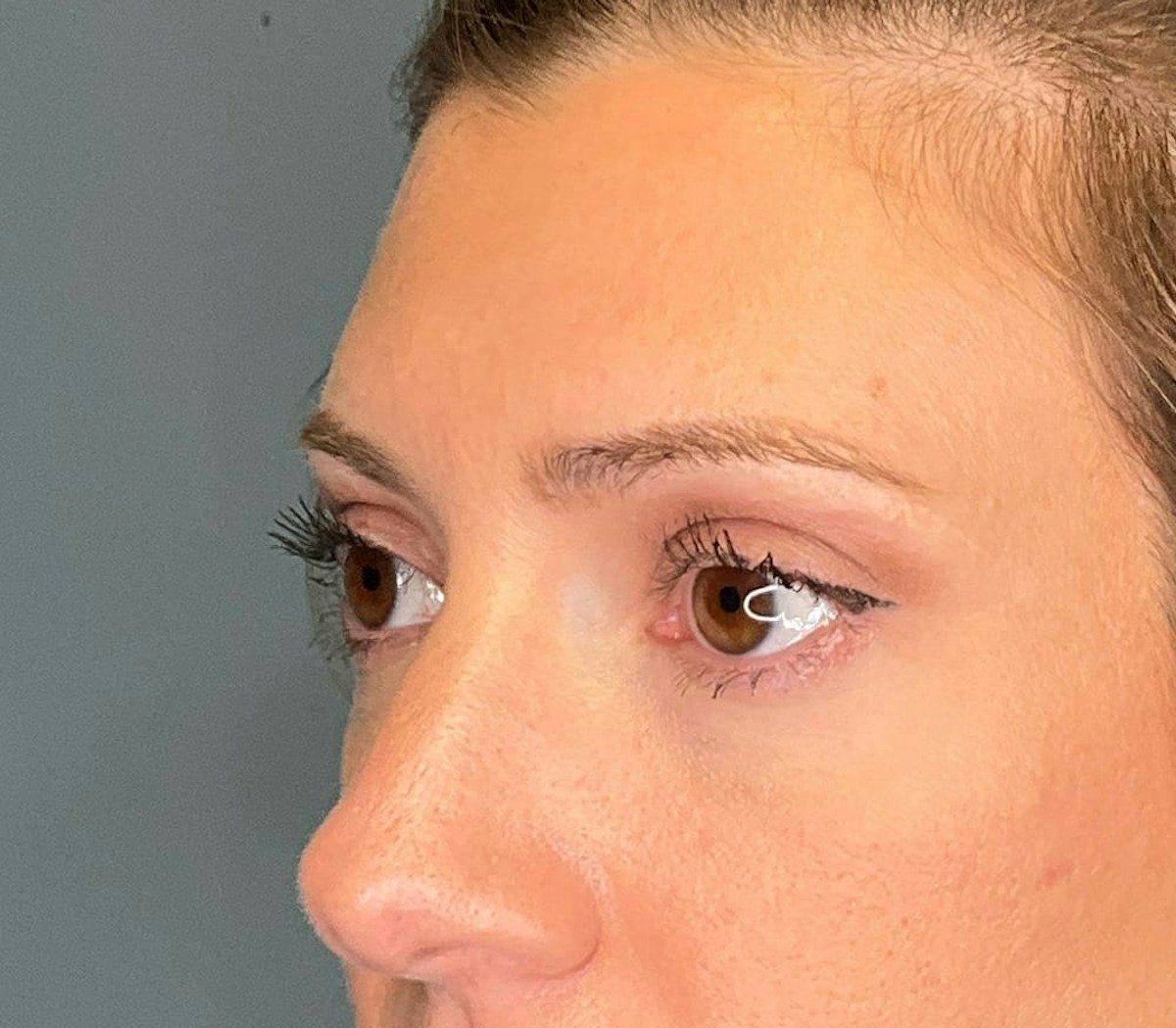 Blepharoplasty Before & After Gallery - Patient 186023 - Image 4