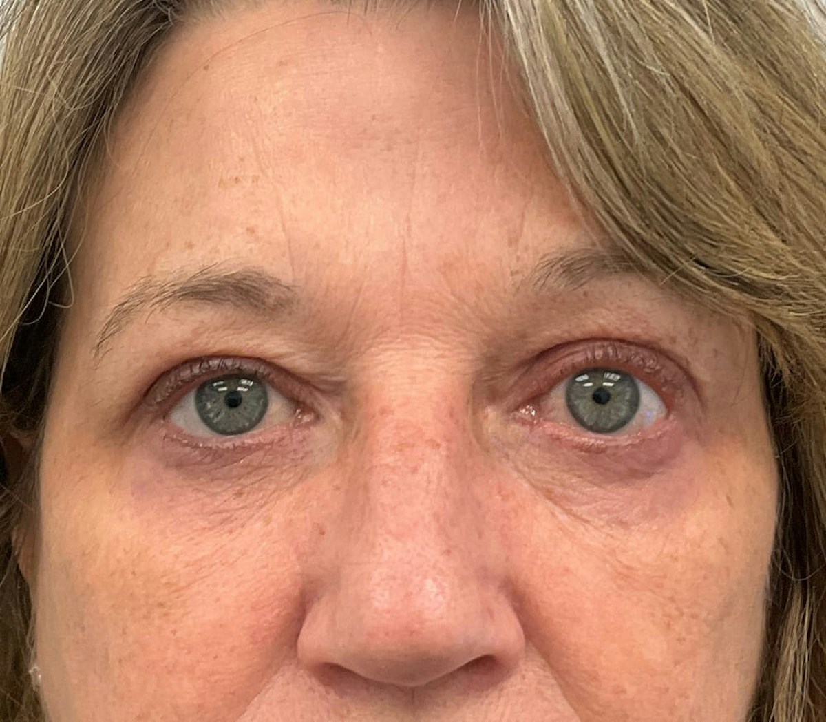 Blepharoplasty Before & After Gallery - Patient 273889 - Image 4