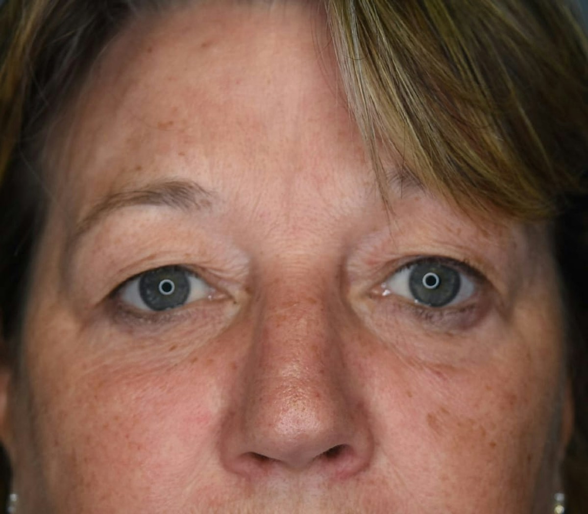 Blepharoplasty Before & After Gallery - Patient 273889 - Image 3