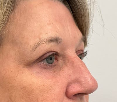 Blepharoplasty Before & After Gallery - Patient 273889 - Image 2