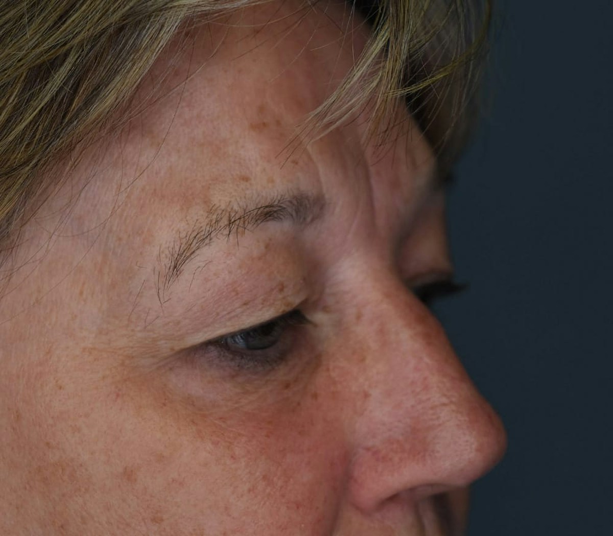 Blepharoplasty Before & After Gallery - Patient 273889 - Image 1