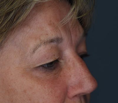 Blepharoplasty Before & After Gallery - Patient 273889 - Image 1