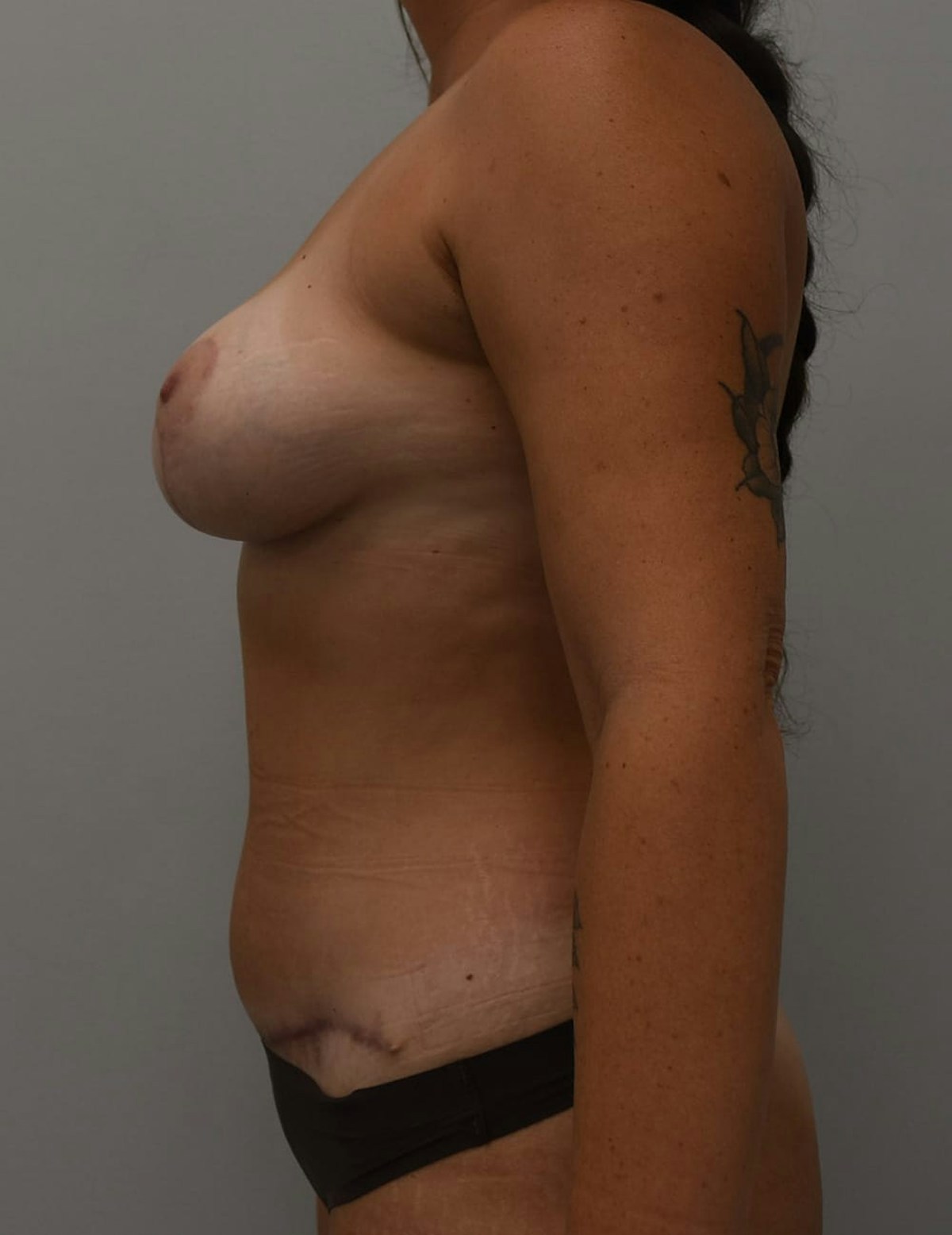 Breast and Tummy Before & After Gallery - Patient 248447 - Image 6