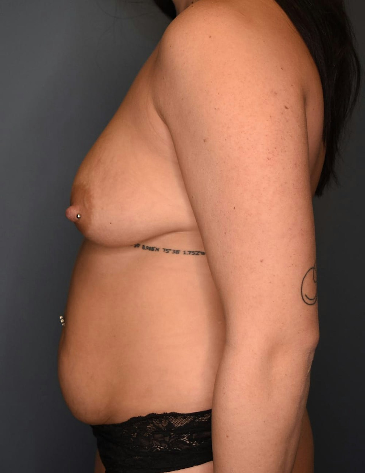 Breast and Tummy Before & After Gallery - Patient 945726 - Image 5