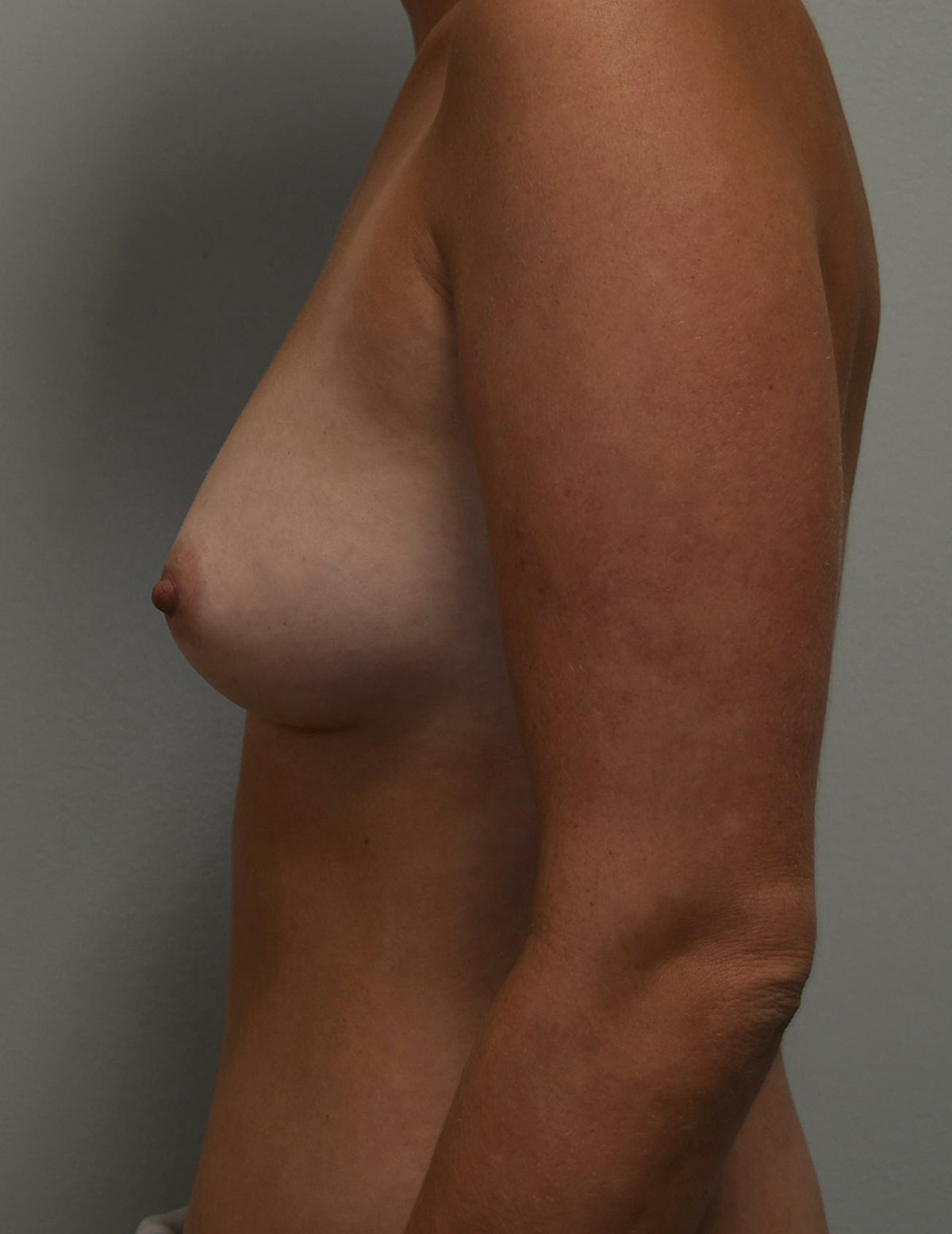 Breast Augmentation Before & After Gallery - Patient 428955 - Image 5