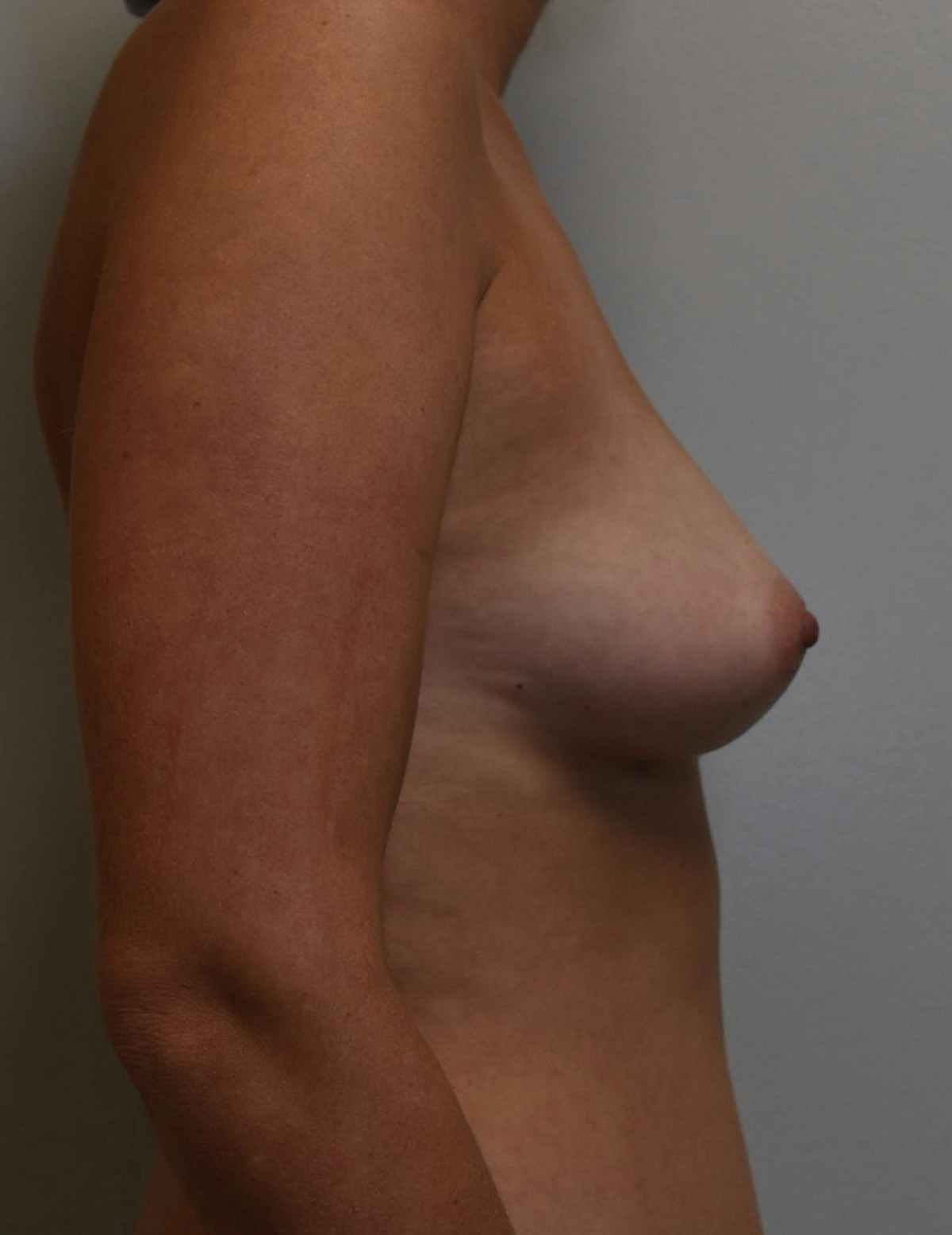 Breast Augmentation Before & After Gallery - Patient 428955 - Image 7