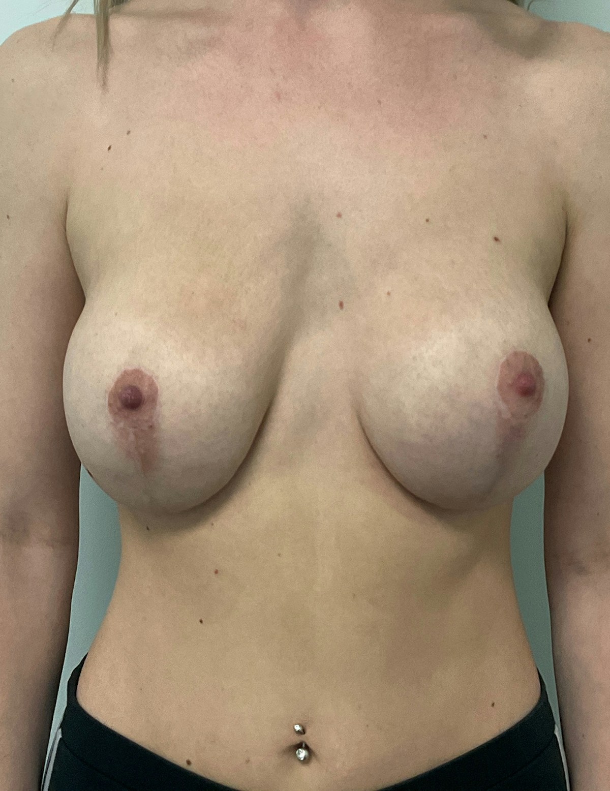 Breast Augmentation Before & After Gallery - Patient 611405 - Image 10