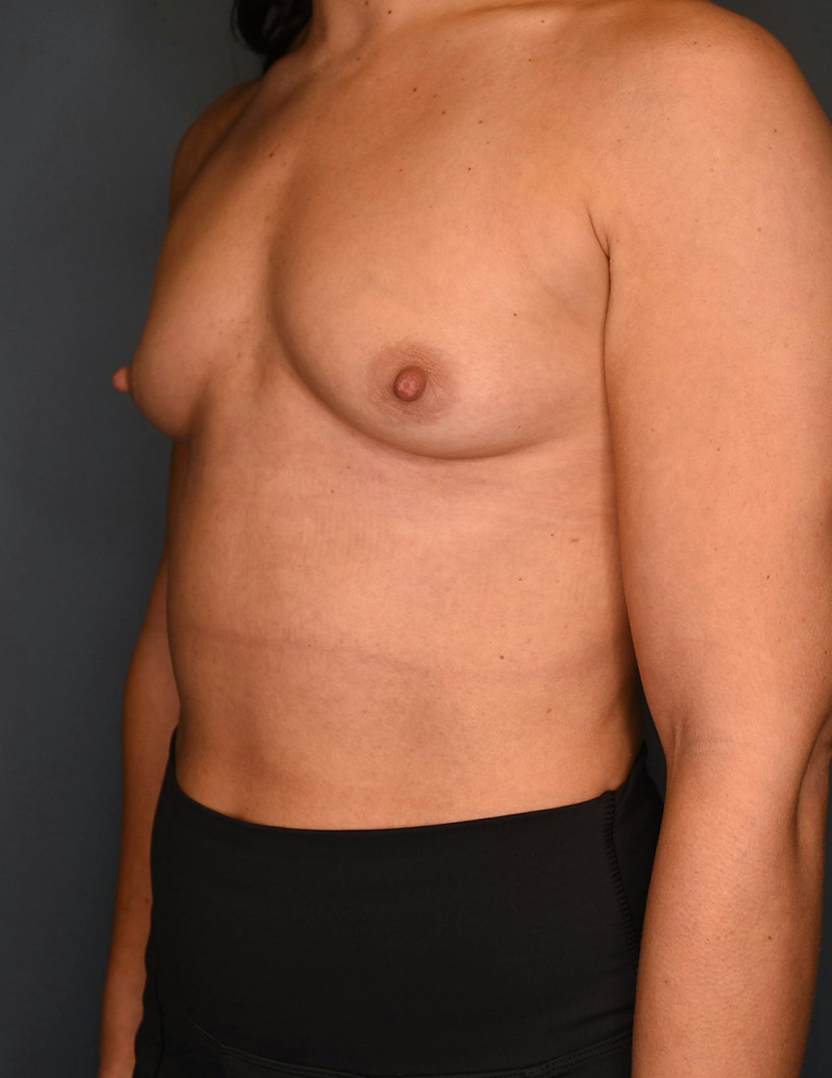 Breast Augmentation Before & After Gallery - Patient 486348 - Image 1