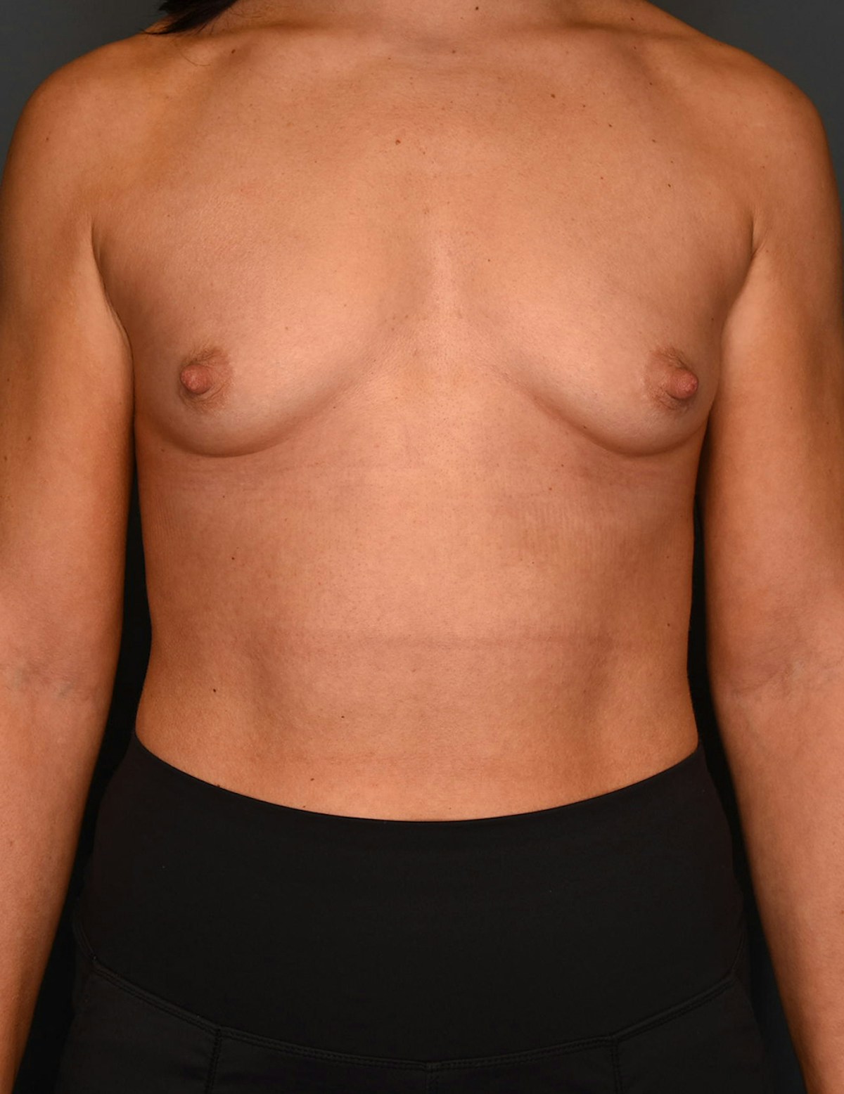 Breast Augmentation Before & After Gallery - Patient 486348 - Image 9