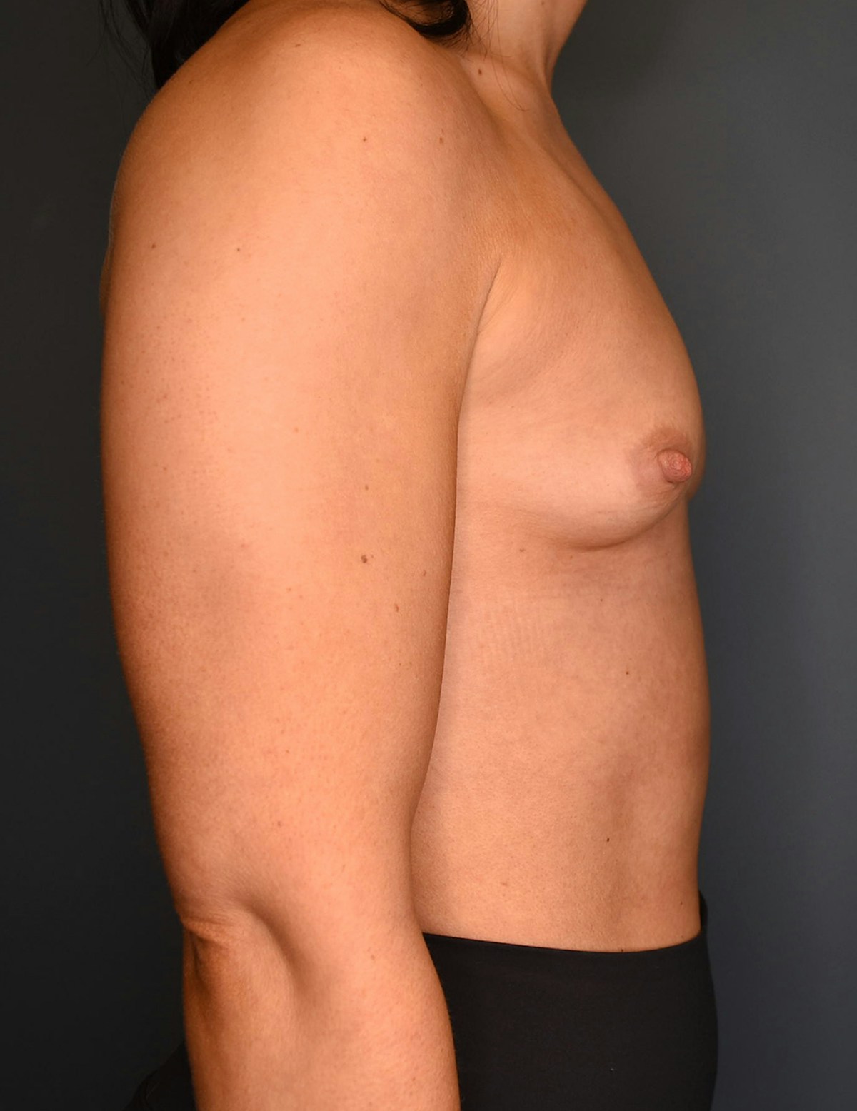 Breast Augmentation Before & After Gallery - Patient 486348 - Image 7