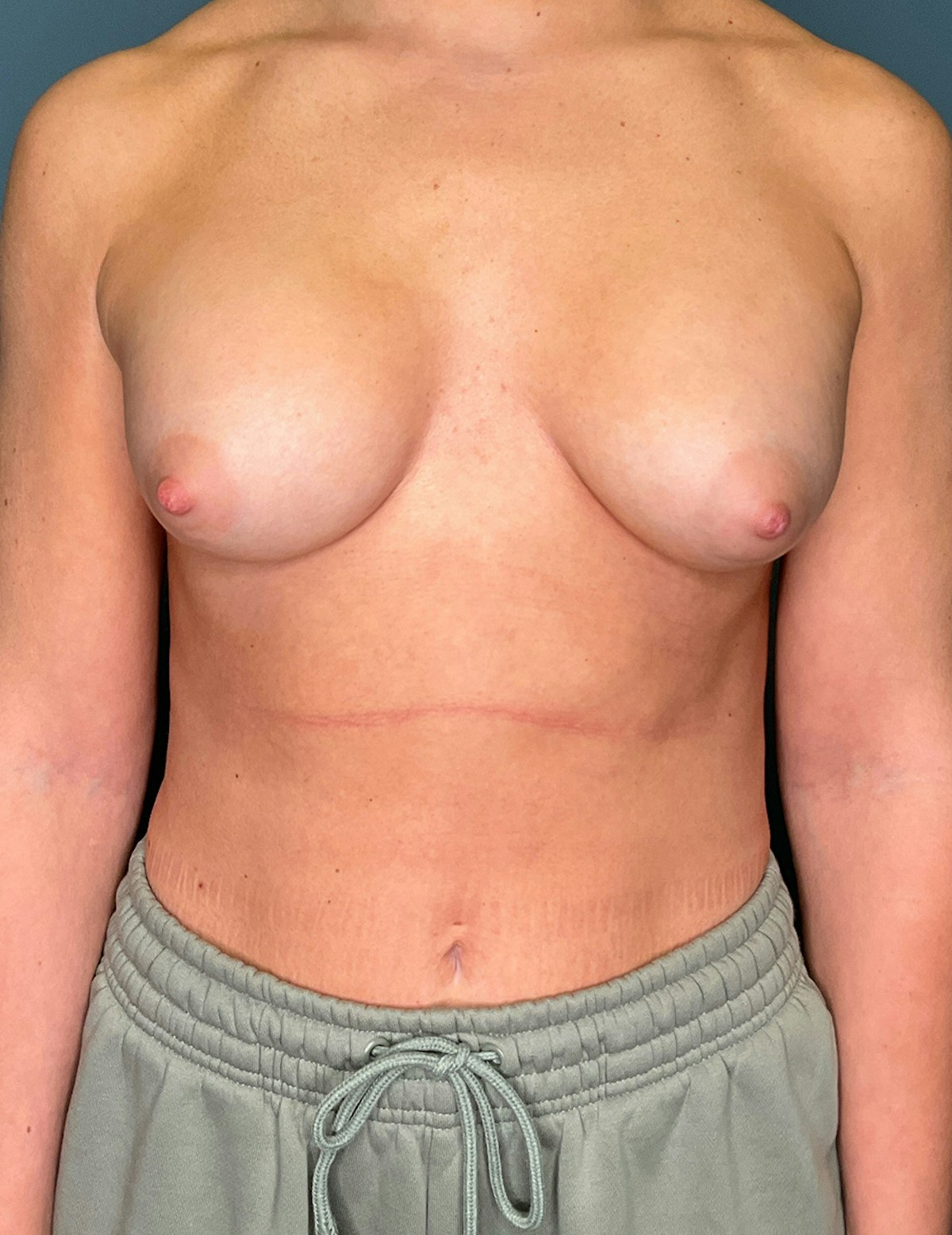 Breast Augmentation Before & After Gallery - Patient 486348 - Image 10