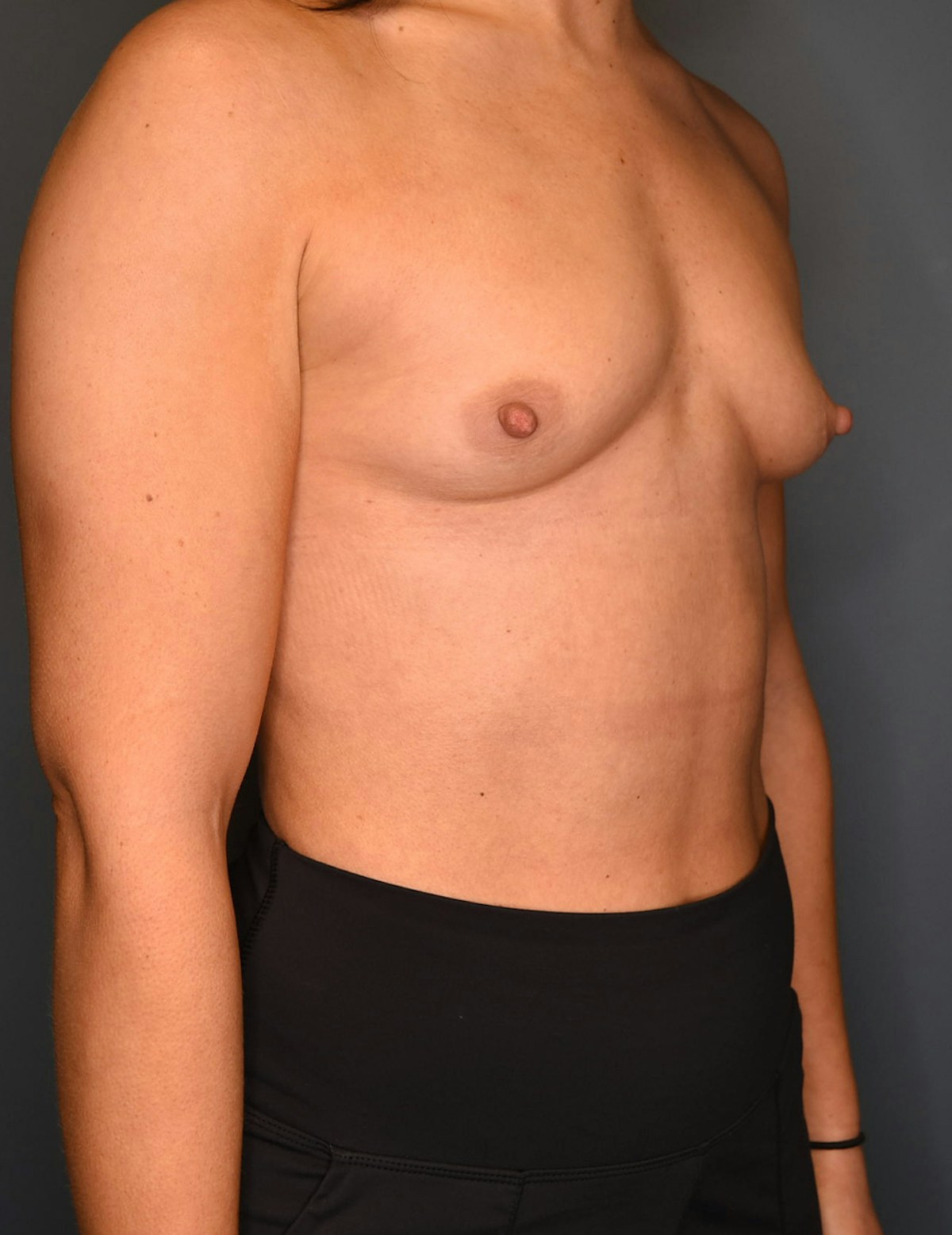 Breast Augmentation Before & After Gallery - Patient 486348 - Image 3