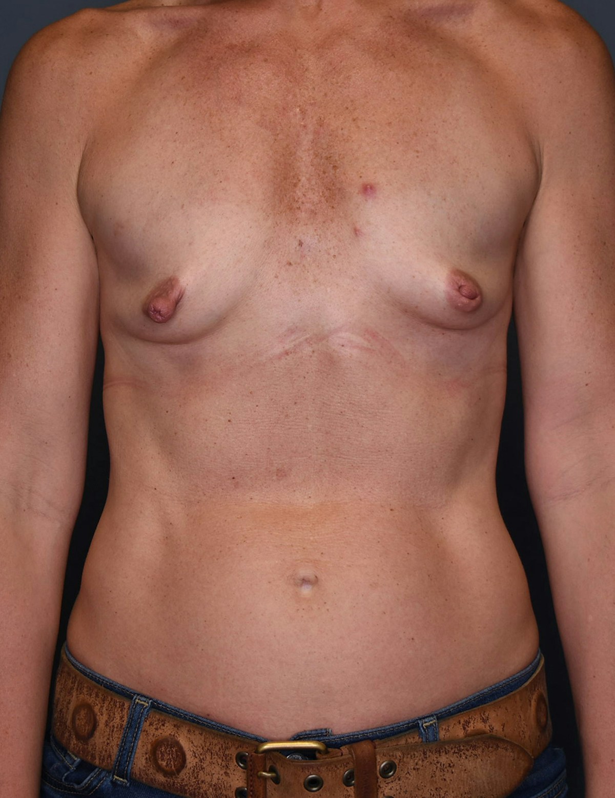 Breast Augmentation Before & After Gallery - Patient 164555 - Image 9