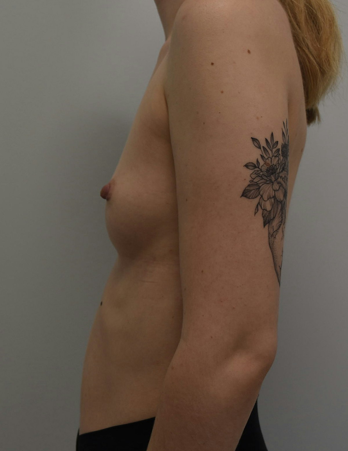 Breast Augmentation Before & After Gallery - Patient 599184 - Image 5