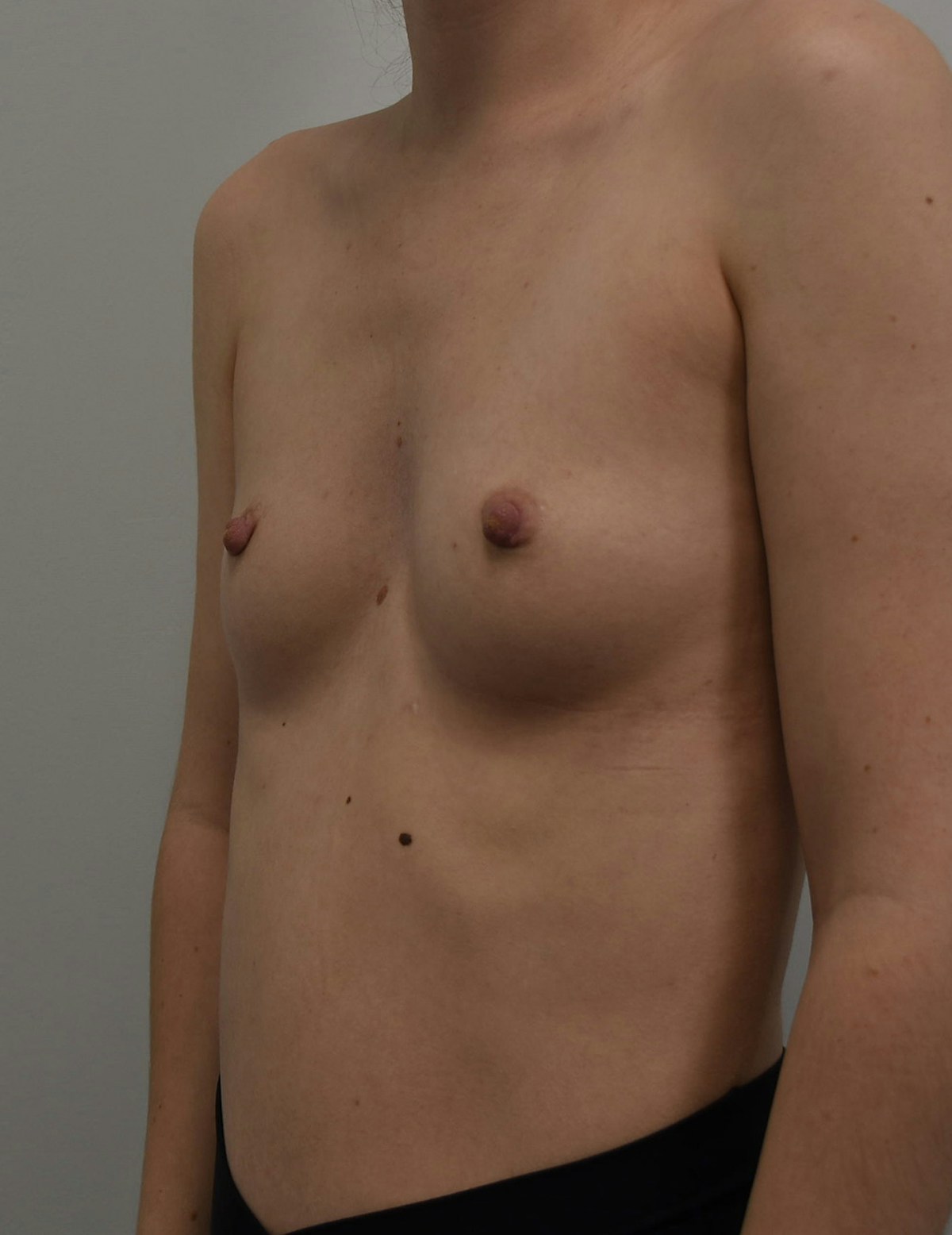Breast Augmentation Before & After Gallery - Patient 599184 - Image 1