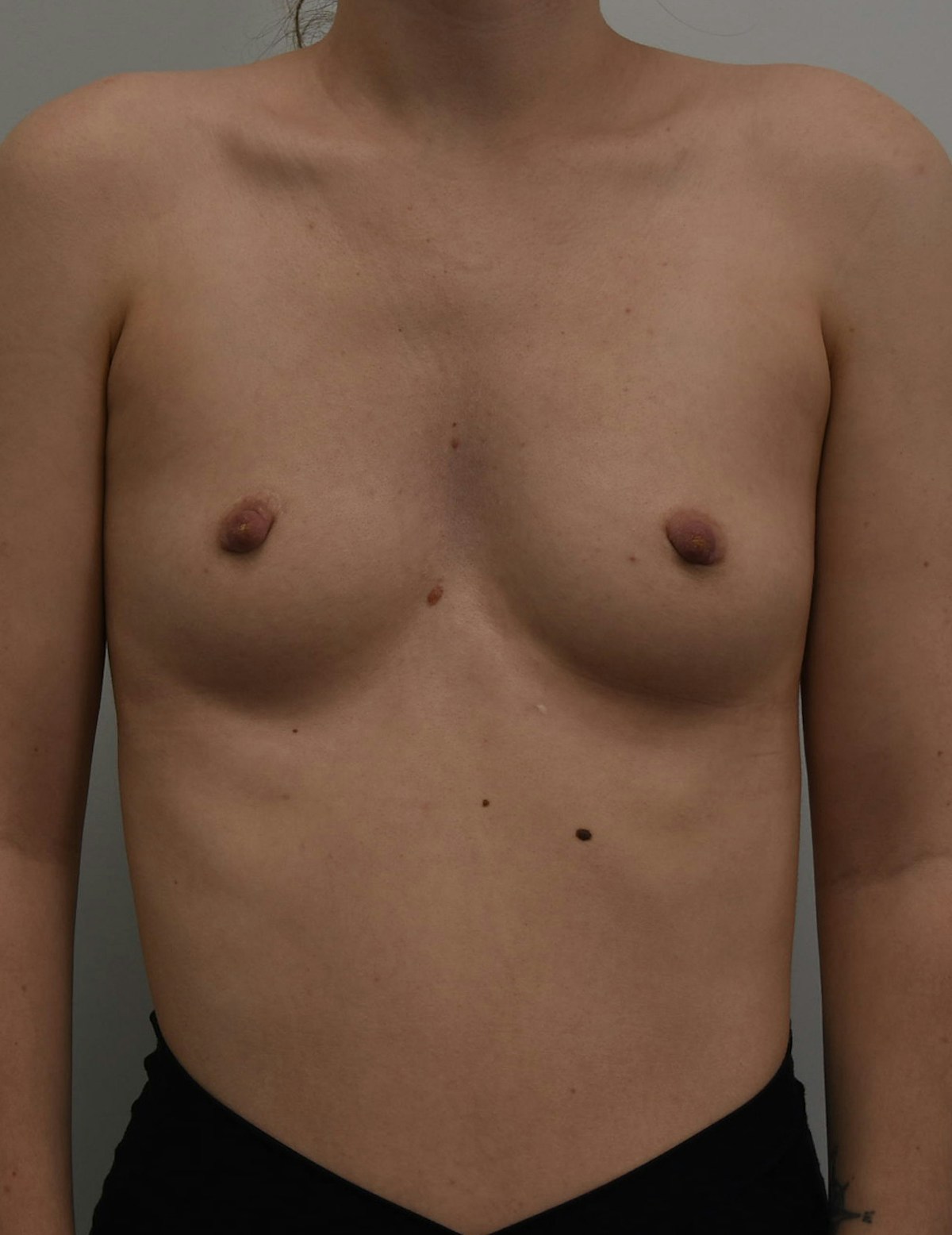Breast Augmentation Before & After Gallery - Patient 599184 - Image 10